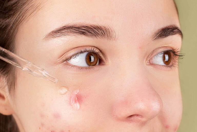 application cbd sur acné