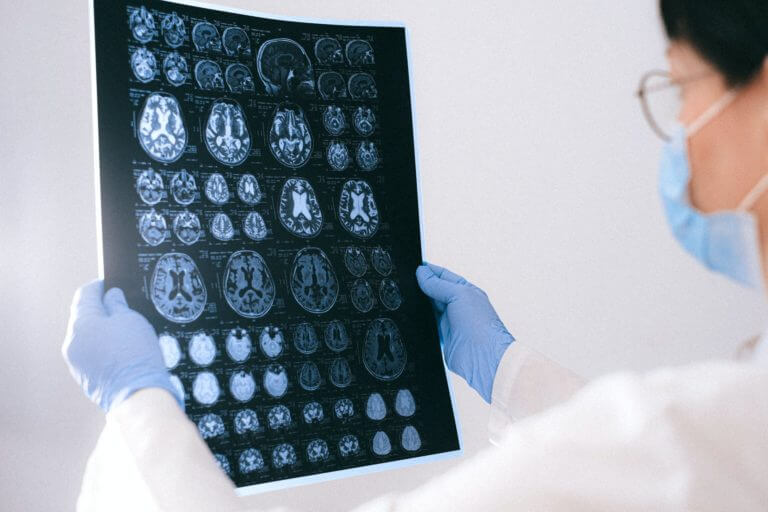 cerveau reaction crise epilepsie sans cbd